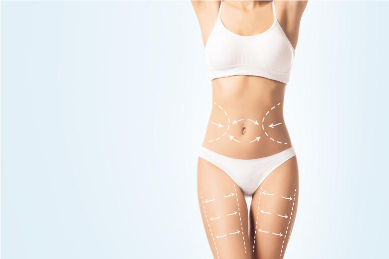 Frauenkörper mit Markierungen an Bauch, Hüfte und Beinen, die Problemzonen zeigen.